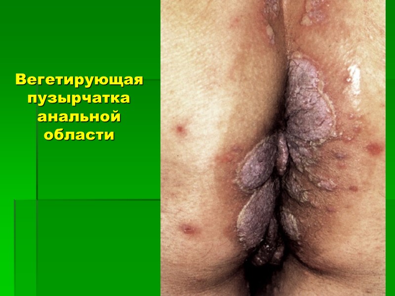 Вегетирующая пузырчатка анальной области